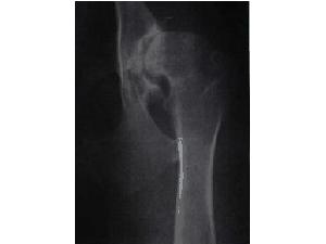 DKK - dysplazie ky�eln�ch kloub�