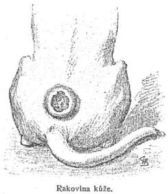 Rakovina k��e